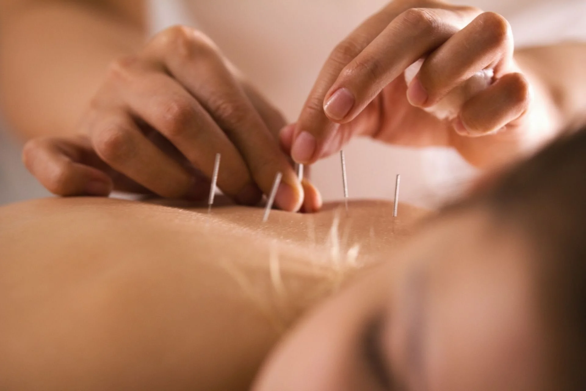 Dry needling treatment at Elevate Wellness St. Pete