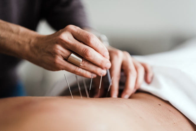 Trigger point mapping and dry needling assessment at Elevate Wellness St. Pete